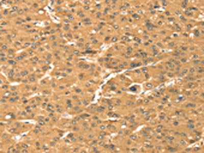The image on the left is immunohistochemistry of paraffin-embedded Human liver cancer tissue using CSB-PA292200(TMEM123 Antibody) at dilution 1/25, on the right is treated with fusion protein. (Original magnification: ×200)