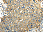 The image on the left is immunohistochemistry of paraffin-embedded Human breast cancer tissue using CSB-PA292244(PKM Antibody) at dilution 1/25, on the right is treated with synthetic peptide. (Original magnification: ×200)