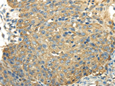 The image on the left is immunohistochemistry of paraffin-embedded Human breast cancer tissue using CSB-PA292244(PKM Antibody) at dilution 1/25, on the right is treated with synthetic peptide. (Original magnification: ×200)