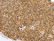 The image on the left is immunohistochemistry of paraffin-embedded Human esophagus cancer tissue using CSB-PA292260(VMP1 Antibody) at dilution 1/35, on the right is treated with synthetic peptide. (Original magnification: ×200)