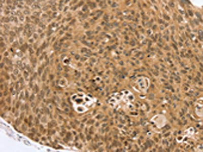 The image on the left is immunohistochemistry of paraffin-embedded Human esophagus cancer tissue using CSB-PA292260(VMP1 Antibody) at dilution 1/35, on the right is treated with synthetic peptide. (Original magnification: ×200)