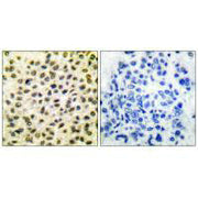 Immunohistochemical analysis of paraffin-embedded human breast carcinoma tissue using Fos antibody.