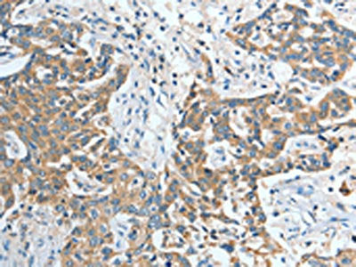 The image on the left is immunohistochemistry of paraffin-embedded Human esophagus cancer tissue using CSB-PA292651(IL12RB1 Antibody) at dilution 1/20, on the right is treated with fusion protein. (Original magnification: ×200)