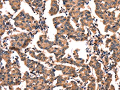 The image on the left is immunohistochemistry of paraffin-embedded Human breast cancer tissue using CSB-PA292680(CGA Antibody) at dilution 1/65, on the right is treated with fusion protein. (Original magnification: ×200)