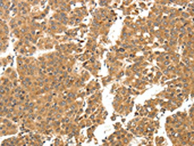 The image on the left is immunohistochemistry of paraffin-embedded Human breast cancer tissue using CSB-PA292717(LYZ Antibody) at dilution 1/20, on the right is treated with fusion protein. (Original magnification: ×200)