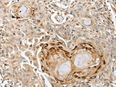 The image on the left is immunohistochemistry of paraffin-embedded Human esophagus cancer tissue using CSB-PA292803(SLC1A7 Antibody) at dilution 1/35, on the right is treated with synthetic peptide. (Original magnification: ×200)