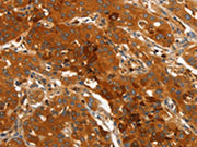 The image on the left is immunohistochemistry of paraffin-embedded Human lung cancer tissue using CSB-PA292969(ORM2 Antibody) at dilution 1/40, on the right is treated with fusion protein. (Original magnification: ×200)