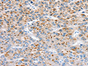 The image on the left is immunohistochemistry of paraffin-embedded Human liver cancer tissue using CSB-PA292985(CCS Antibody) at dilution 1/30, on the right is treated with synthetic peptide. (Original magnification: ×200)