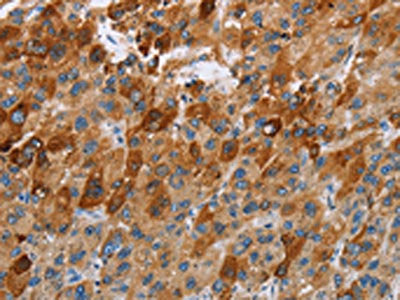 The image on the left is immunohistochemistry of paraffin-embedded Human liver cancer tissue using CSB-PA293047(CCR9 Antibody) at dilution 1/40, on the right is treated with fusion protein. (Original magnification: ×200)
