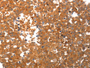 The image on the left is immunohistochemistry of paraffin-embedded Human breast cancer tissue using CSB-PA293075(PPAP2C Antibody) at dilution 1/40, on the right is treated with synthetic peptide. (Original magnification: ×200)