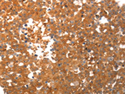 The image on the left is immunohistochemistry of paraffin-embedded Human breast cancer tissue using CSB-PA293075(PPAP2C Antibody) at dilution 1/40, on the right is treated with synthetic peptide. (Original magnification: ×200)