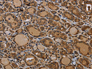 The image on the left is immunohistochemistry of paraffin-embedded Human thyroid cancer tissue using CSB-PA293314(GJB4 Antibody) at dilution 1/50, on the right is treated with synthetic peptide. (Original magnification: ×200)