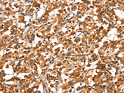 The image on the left is immunohistochemistry of paraffin-embedded Human thyroid cancer tissue using CSB-PA293420(DDAH2 Antibody) at dilution 1/20, on the right is treated with synthetic peptide. (Original magnification: ×200)