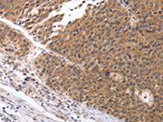 The image on the left is immunohistochemistry of paraffin-embedded Human ovarian cancer tissue using CSB-PA293526(GEMIN2 Antibody) at dilution 1/25, on the right is treated with synthetic peptide. (Original magnification: ×200)