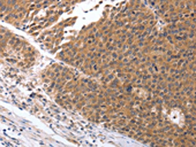 The image on the left is immunohistochemistry of paraffin-embedded Human ovarian cancer tissue using CSB-PA293526(GEMIN2 Antibody) at dilution 1/25, on the right is treated with synthetic peptide. (Original magnification: ×200)