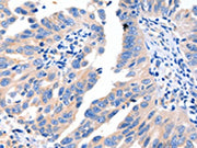 The image on the left is immunohistochemistry of paraffin-embedded Human breast cancer tissue using CSB-PA293957(MSTN Antibody) at dilution 1/8, on the right is treated with synthetic peptide. (Original magnification: ×200)