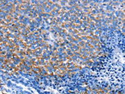 The image on the left is immunohistochemistry of paraffin-embedded Human ovarian cancer tissue using CSB-PA293996(CXCL3 Antibody) at dilution 1/25, on the right is treated with fusion protein. (Original magnification: ×200)