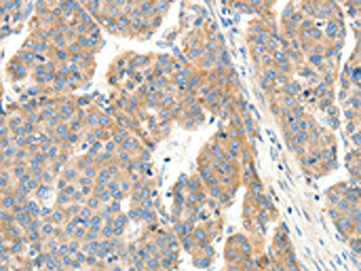 The image on the left is immunohistochemistry of paraffin-embedded Human ovarian cancer tissue using CSB-PA294012(COL4A1 Antibody) at dilution 1/30, on the right is treated with synthetic peptide. (Original magnification: ×200)