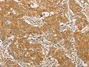 The image on the left is immunohistochemistry of paraffin-embedded Human gastic cancer tissue using CSB-PA294068(SNAP91 Antibody) at dilution 1/20, on the right is treated with fusion protein. (Original magnification: ×200)