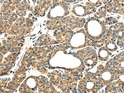 The image on the left is immunohistochemistry of paraffin-embedded Human thyroid cancer tissue using CSB-PA294107(MMP9 Antibody) at dilution 1/20, on the right is treated with synthetic peptide. (Original magnification: ×200)