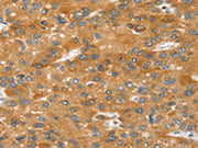 The image on the left is immunohistochemistry of paraffin-embedded Human liver cancer tissue using CSB-PA294488(SRGAP2 Antibody) at dilution 1/20, on the right is treated with synthetic peptide. (Original magnification: ×200)