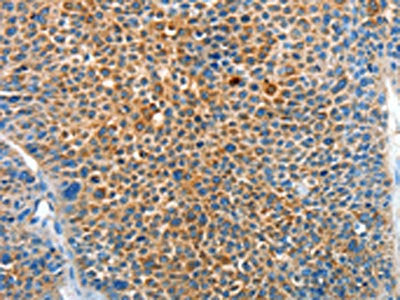 The image on the left is immunohistochemistry of paraffin-embedded Human liver cancer tissue using CSB-PA294574(SERPINF2 Antibody) at dilution 1/50, on the right is treated with synthetic peptide. (Original magnification: ×200)