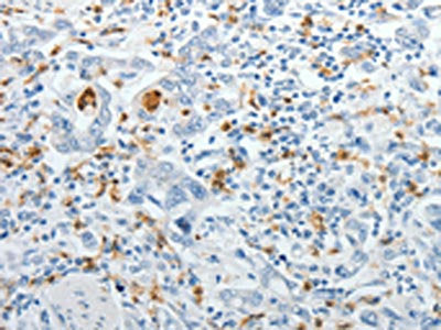 The image on the left is immunohistochemistry of paraffin-embedded Human gastic cancer tissue using CSB-PA294602(TOP1MT Antibody) at dilution 1/10, on the right is treated with synthetic peptide. (Original magnification: ×200)