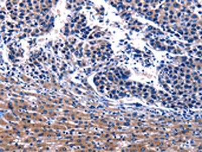 The image on the left is immunohistochemistry of paraffin-embedded Human liver cancer tissue using CSB-PA294860(IRS4 Antibody) at dilution 1/17, on the right is treated with synthetic peptide. (Original magnification: ×200)