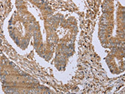 The image on the left is immunohistochemistry of paraffin-embedded Human colon cancer tissue using CSB-PA295162(FHL1 Antibody) at dilution 1/20, on the right is treated with fusion protein. (Original magnification: ×200)