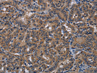 The image on the left is immunohistochemistry of paraffin-embedded Human thyroid cancer tissue using CSB-PA295171(PDE4A Antibody) at dilution 1/40, on the right is treated with synthetic peptide. (Original magnification: ×200)