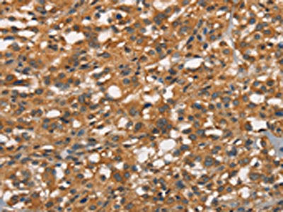 The image on the left is immunohistochemistry of paraffin-embedded Human thyroid cancer tissue using CSB-PA295215(APOC4 Antibody) at dilution 1/20, on the right is treated with synthetic peptide. (Original magnification: ×200)