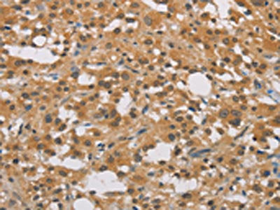 The image on the left is immunohistochemistry of paraffin-embedded Human thyroid cancer tissue using CSB-PA295249(DDX43 Antibody) at dilution 1/40, on the right is treated with fusion protein. (Original magnification: ×200)