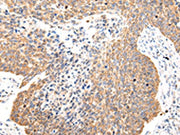 The image on the left is immunohistochemistry of paraffin-embedded Human lung cancer tissue using CSB-PA295305(COL8A2 Antibody) at dilution 1/20, on the right is treated with synthetic peptide. (Original magnification: ×200)