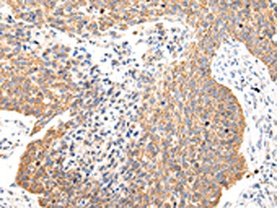 The image on the left is immunohistochemistry of paraffin-embedded Human lung cancer tissue using CSB-PA295305(COL8A2 Antibody) at dilution 1/20, on the right is treated with synthetic peptide. (Original magnification: ×200)