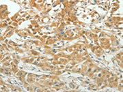 The image on the left is immunohistochemistry of paraffin-embedded Human lung cancer tissue using CSB-PA295467(PAX5 Antibody) at dilution 1/20, on the right is treated with synthetic peptide. (Original magnification: ×200)