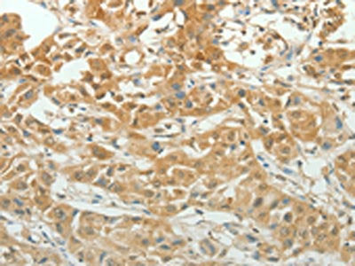 The image on the left is immunohistochemistry of paraffin-embedded Human lung cancer tissue using CSB-PA295467(PAX5 Antibody) at dilution 1/20, on the right is treated with synthetic peptide. (Original magnification: ×200)