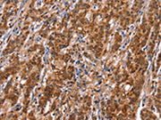 The image on the left is immunohistochemistry of paraffin-embedded Human gastic cancer tissue using CSB-PA295592(TDP2 Antibody) at dilution 1/40, on the right is treated with synthetic peptide. (Original magnification: ×200)