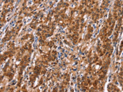 The image on the left is immunohistochemistry of paraffin-embedded Human gastic cancer tissue using CSB-PA295592(TDP2 Antibody) at dilution 1/40, on the right is treated with synthetic peptide. (Original magnification: ×200)