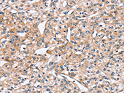 The image on the left is immunohistochemistry of paraffin-embedded Human prostate cancer tissue using CSB-PA295602(PEA15 Antibody) at dilution 1/20, on the right is treated with fusion protein. (Original magnification: ×200)