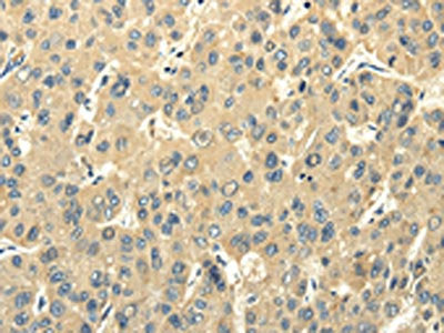 The image on the left is immunohistochemistry of paraffin-embedded Human liver cancer tissue using CSB-PA295677(PMP2 Antibody) at dilution 1/25, on the right is treated with fusion protein. (Original magnification: ×200)