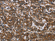 The image on the left is immunohistochemistry of paraffin-embedded Human liver cancer tissue using CSB-PA295755(NCKAP1 Antibody) at dilution 1/30, on the right is treated with synthetic peptide. (Original magnification: ×200)