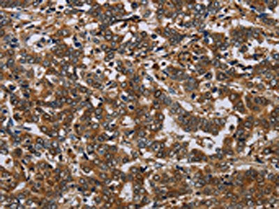 The image on the left is immunohistochemistry of paraffin-embedded Human liver cancer tissue using CSB-PA295755(NCKAP1 Antibody) at dilution 1/30, on the right is treated with synthetic peptide. (Original magnification: ×200)