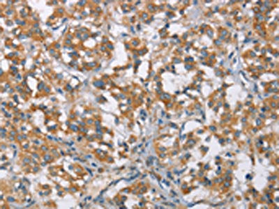 The image on the left is immunohistochemistry of paraffin-embedded Human thyroid cancer tissue using CSB-PA295852(TLR6 Antibody) at dilution 1/25, on the right is treated with synthetic peptide. (Original magnification: ×200)