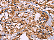 The image on the left is immunohistochemistry of paraffin-embedded Human thyroid cancer tissue using CSB-PA296044(HIST1H1C Antibody) at dilution 1/70, on the right is treated with fusion protein. (Original magnification: ×200)