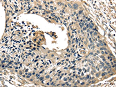 The image on the left is immunohistochemistry of paraffin-embedded Human esophagus cancer tissue using CSB-PA296101(TXNIP Antibody) at dilution 1/40, on the right is treated with synthetic peptide. (Original magnification: ×200)