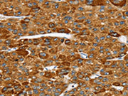 The image on the left is immunohistochemistry of paraffin-embedded Human liver cancer tissue using CSB-PA296531(SPARCL1 Antibody) at dilution 1/30, on the right is treated with synthetic peptide. (Original magnification: ×200)