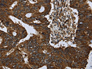 The image on the left is immunohistochemistry of paraffin-embedded Human colon cancer tissue using CSB-PA296760(PPP1R13L Antibody) at dilution 1/30, on the right is treated with synthetic peptide. (Original magnification: ×200)