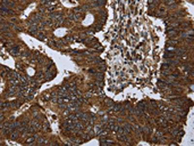 The image on the left is immunohistochemistry of paraffin-embedded Human colon cancer tissue using CSB-PA296760(PPP1R13L Antibody) at dilution 1/30, on the right is treated with synthetic peptide. (Original magnification: ×200)