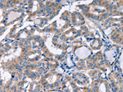 The image on the left is immunohistochemistry of paraffin-embedded Human thyroid cancer tissue using CSB-PA296843(KCNQ5 Antibody) at dilution 1/30, on the right is treated with fusion protein. (Original magnification: ×200)
