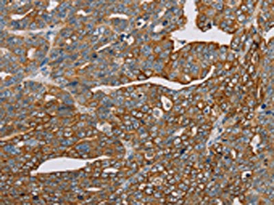 The image on the left is immunohistochemistry of paraffin-embedded Human cervical cancer tissue using CSB-PA296860(MTFP1 Antibody) at dilution 1/30, on the right is treated with fusion protein. (Original magnification: ×200)